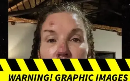 Janice Dickinson Reveals Injury Photos from ‘I’m A Celebrity’ Fall