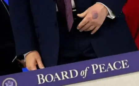 Trump’s Hand Bruised: Photos from Davos Meeting Capture New Injury