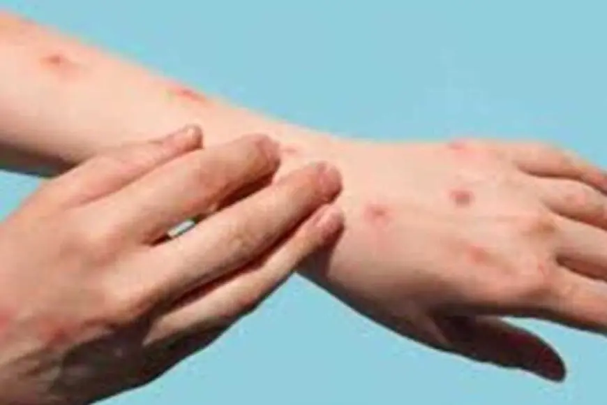 تطورات جديدة في علاج جدري القرود بأفريقيا بعد مراجعة إيجابية لسلامة البيانات