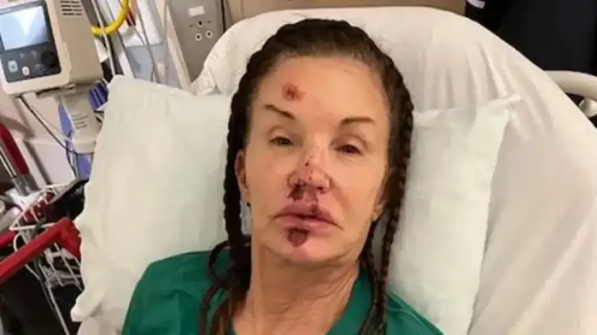 Iconic Model Permanently Disfigured in Shocking Incident