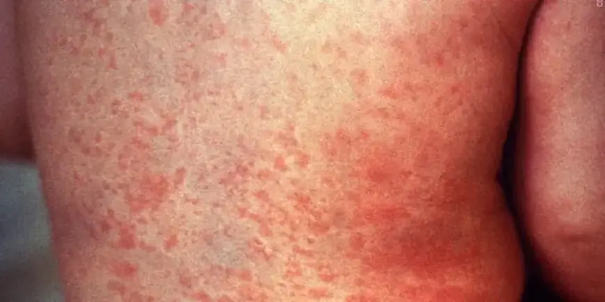 Federal Detainee in Pinal County Diagnosed with Measles, Officials Report