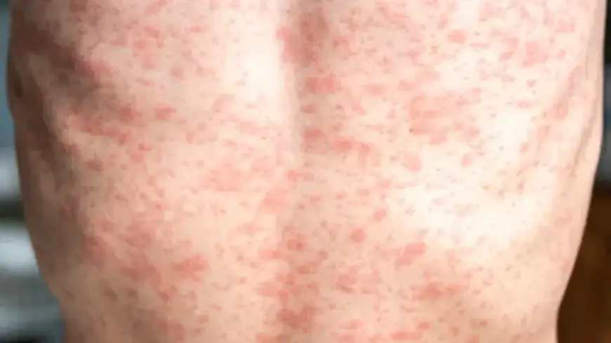 Sydney Faces Increased Measles Risk as New Cases Emerge