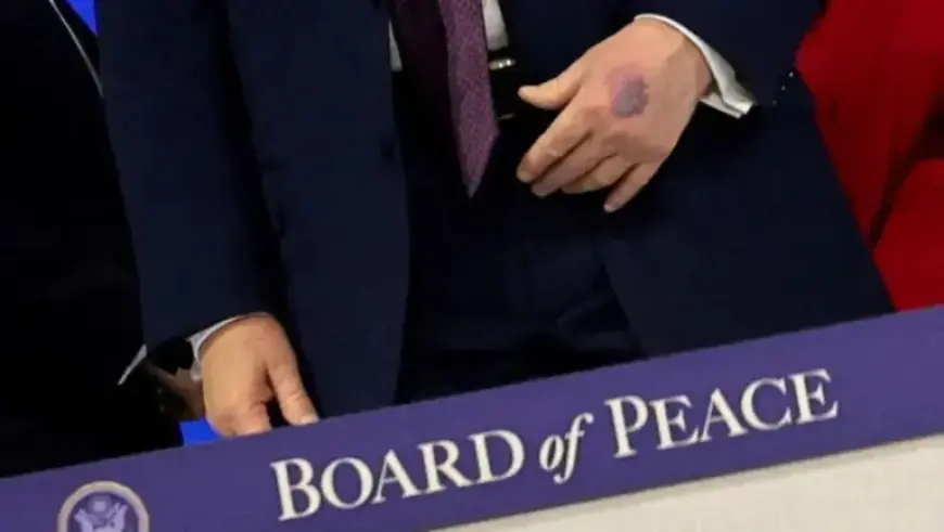 Trump’s Hand Bruised: Photos from Davos Meeting Capture New Injury