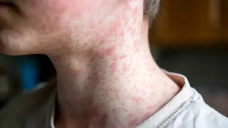 Confirmed Measles Case Visits Montreal-Trudeau Airport and Children’s Hospital