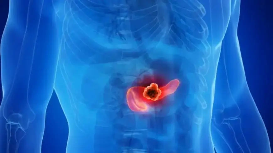 Drug Trio Blocks Tumor Resistance in Pancreatic Cancer Models