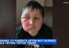 Loyola Medicine Warns After TikTok Trend Leaves Boy Burned by Needoh Cube