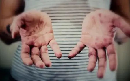 Measles Alert: Infected Individual Visited Four Raleigh Sites, Officials Warn