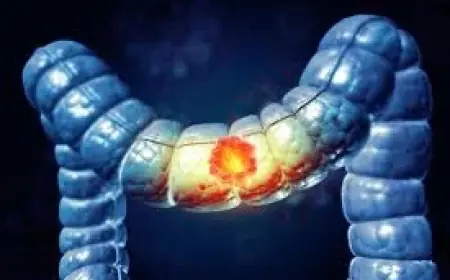 Cancer Colorectal Now Leading Cause of Death Under 50