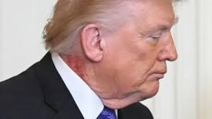 Trump Neck Rash Draws Scrutiny as White House Doctor Says Cream Caused Redness