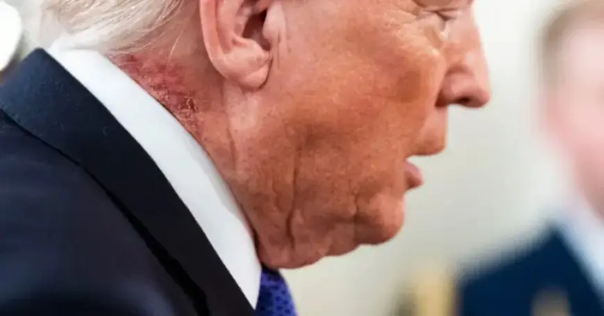President Trump Attends Event Showing Noticeable Red Skin Rash
