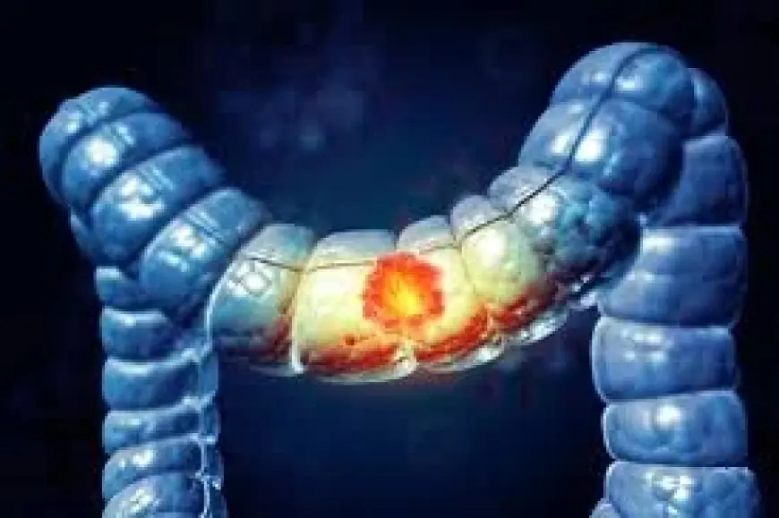 Cancer Colorectal Now Leading Cause of Death Under 50