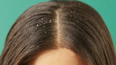 أسباب قشرة الشعر عند النساء