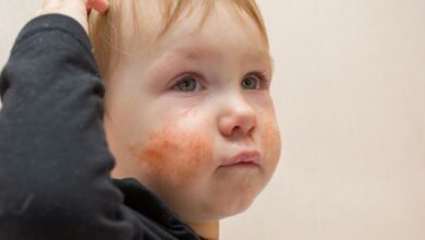 علاج الطفح الجلدي عند الأطفال بالأعشاب