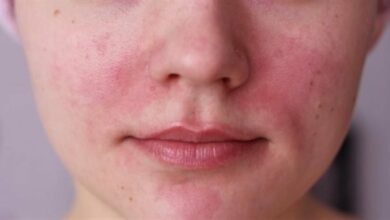 علاج الطفح الجلدي في الوجه